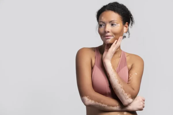 Restore your skin’s natural glow with Ayurvedic Treatment For Skin Disease! 🌱 Ayurveda offers holistic remedies using powerful herbs like Neem, Turmeric, and Aloe Vera to treat acne, eczema, psoriasis, and other skin conditions. Say goodbye to chemical-based treatments and embrace natural healing through herbal therapies, detoxification, and balanced nutrition. Let Ayurveda nurture your skin from within for a radiant, blemish-free look! ✨💚 Visit us now-https://svasthvida.com/services/ayurvedic-treatment-for-skin-care